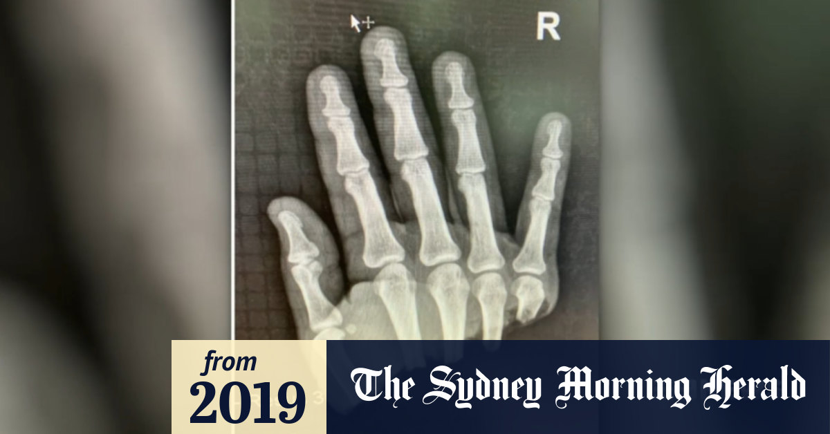 Video Brisbane hand reattachment surgery a success